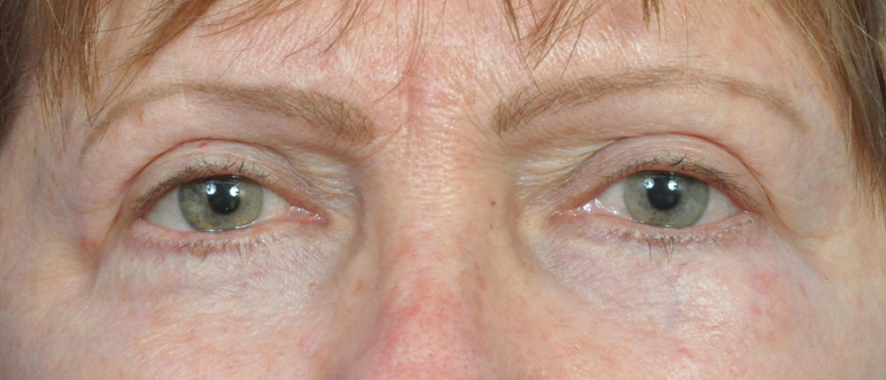 Blepharoplasty Before and After Pictures Jacksonville, FL