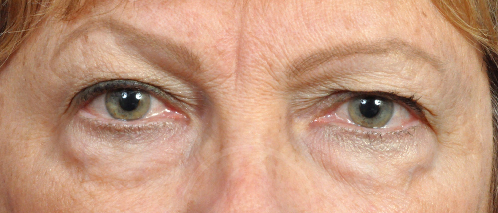 Blepharoplasty Before and After Pictures Jacksonville, FL