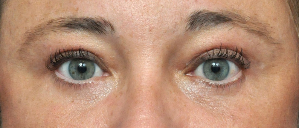 Blepharoplasty Before and After Pictures Jacksonville, FL