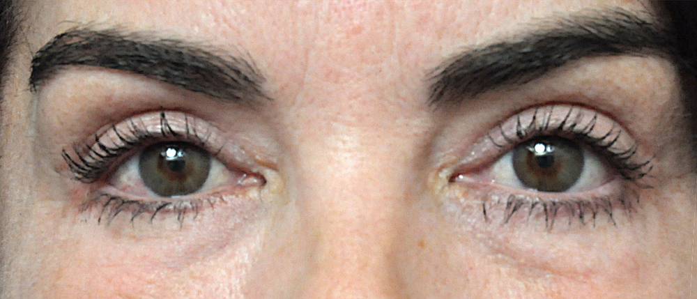 Blepharoplasty Before and After Pictures Jacksonville, FL