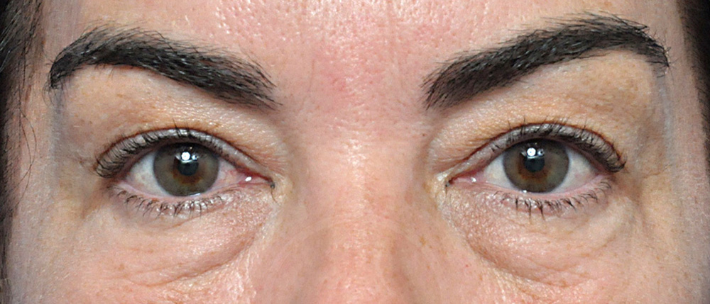 Blepharoplasty Before and After Pictures Jacksonville, FL