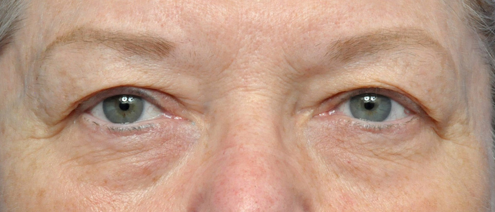 Blepharoplasty Before and After Pictures Jacksonville, FL