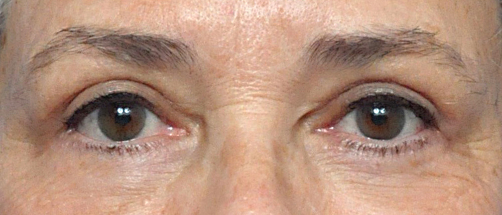 Blepharoplasty Before and After Pictures Jacksonville, FL