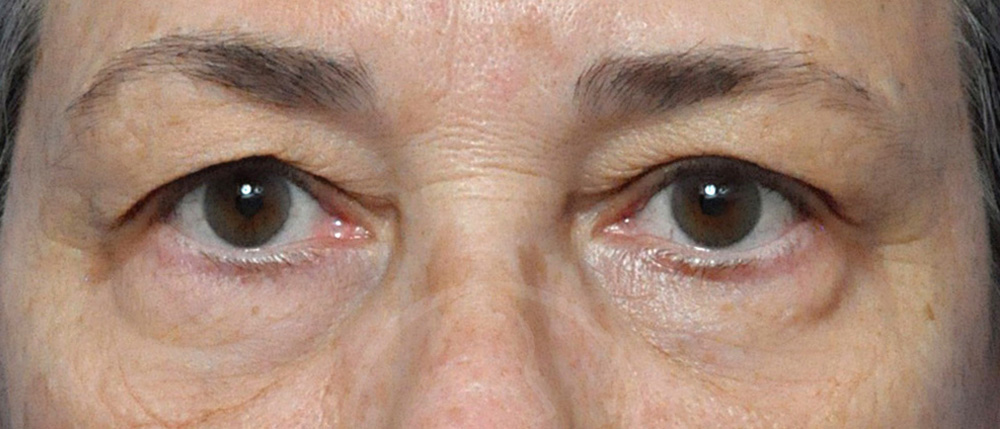 Blepharoplasty Before and After Pictures Jacksonville, FL