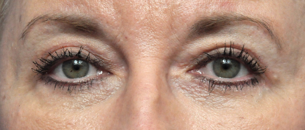 Blepharoplasty Before and After Pictures Jacksonville, FL