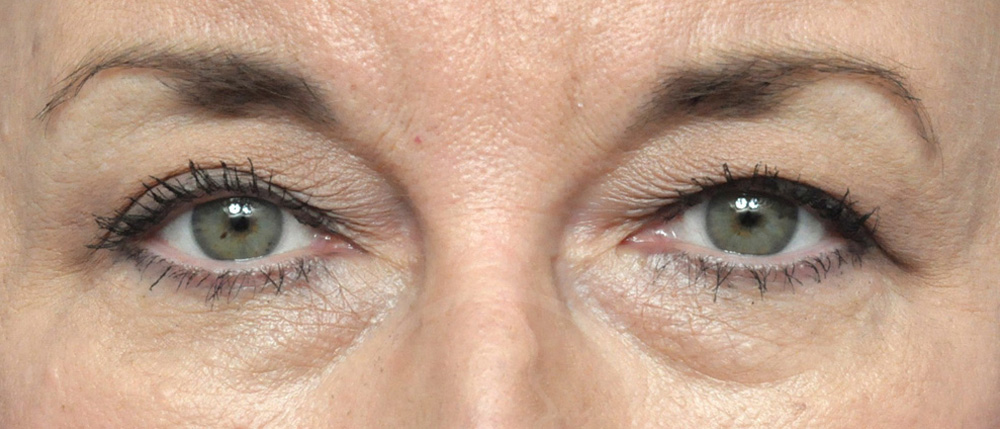 Blepharoplasty Before and After Pictures Jacksonville, FL