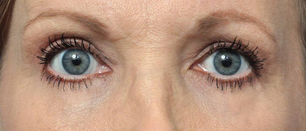 Blepharoplasty Before and After Pictures Jacksonville, FL