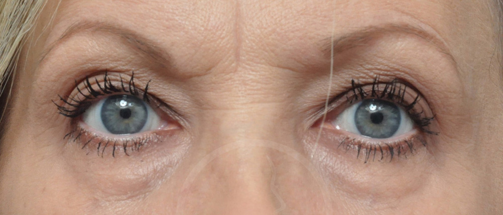 Blepharoplasty Before and After Pictures Jacksonville, FL