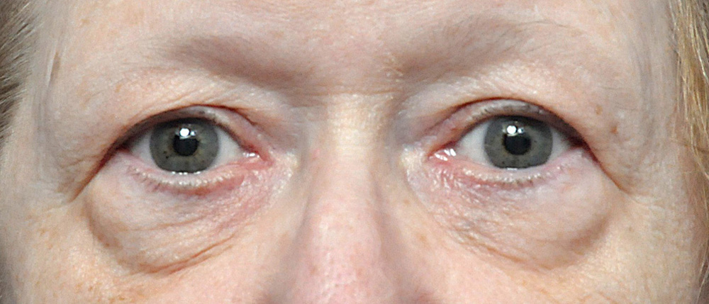 Blepharoplasty Before and After Pictures Jacksonville, FL