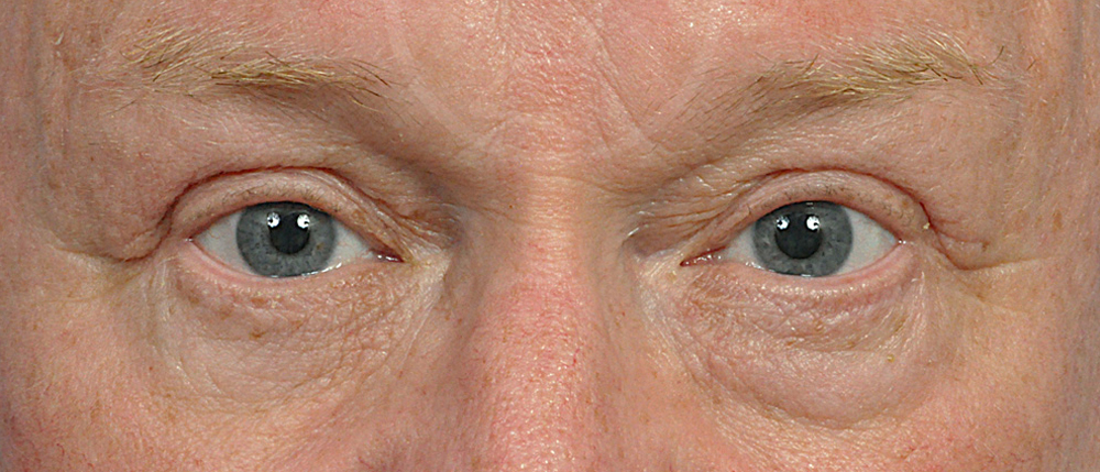 Blepharoplasty Before and After Pictures Jacksonville, FL