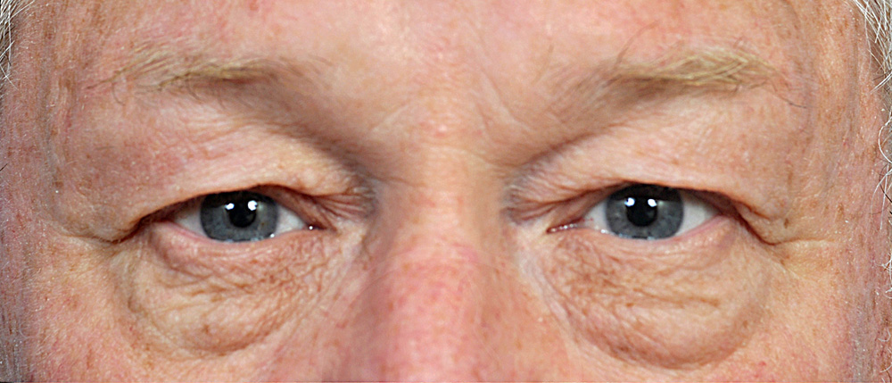 Blepharoplasty Before and After Pictures Jacksonville, FL