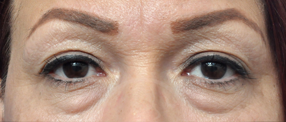 Blepharoplasty Before and After Pictures Jacksonville, FL