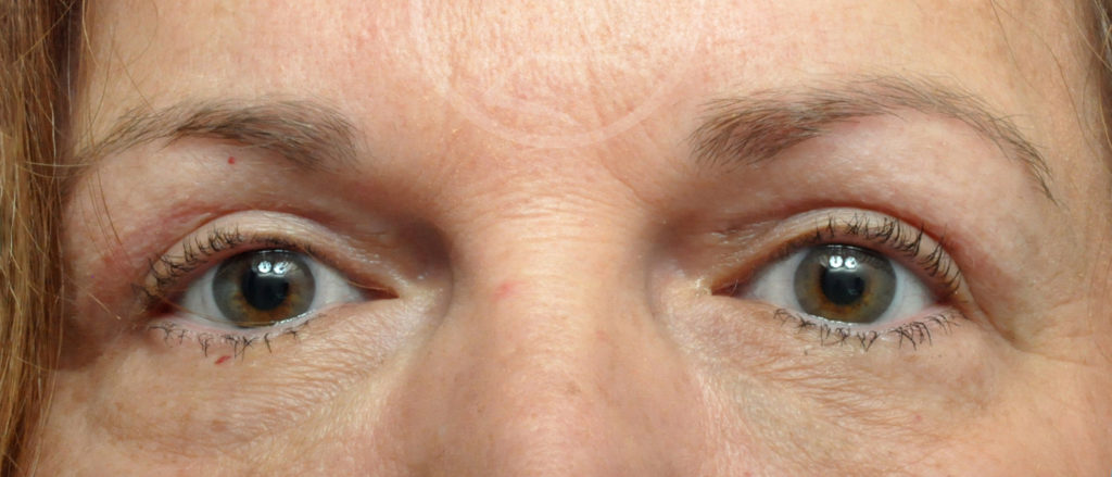 Blepharoplasty Before and After Pictures Jacksonville, FL