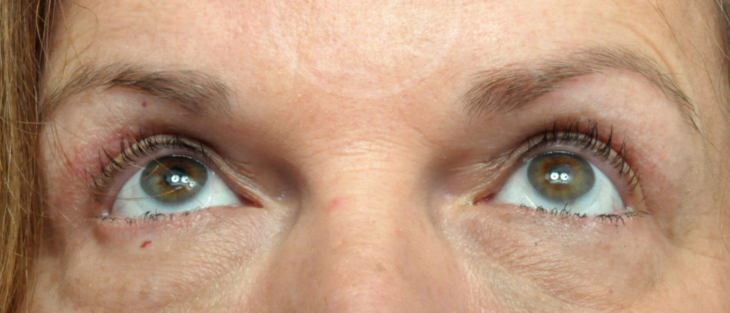 Blepharoplasty Before and After Pictures Jacksonville, FL