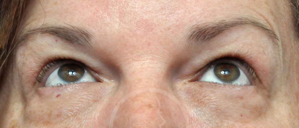 Blepharoplasty Before and After Pictures Jacksonville, FL