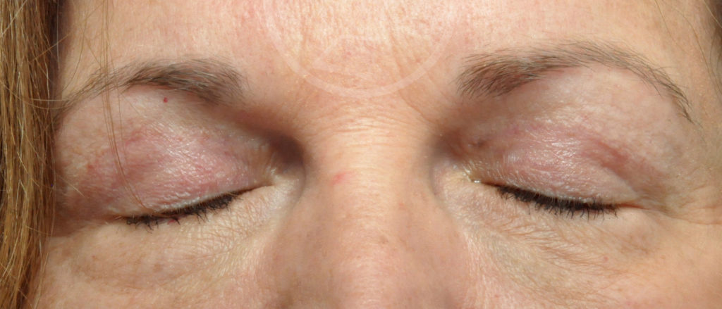 Blepharoplasty Before and After Pictures Jacksonville, FL