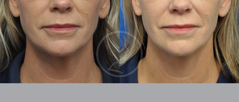 Blepharoplasty Before and After Pictures Jacksonville, FL