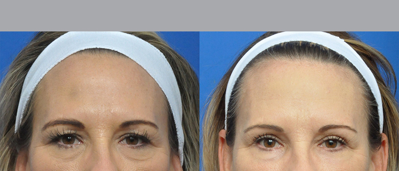 Blepharoplasty Before and After Pictures Jacksonville, FL