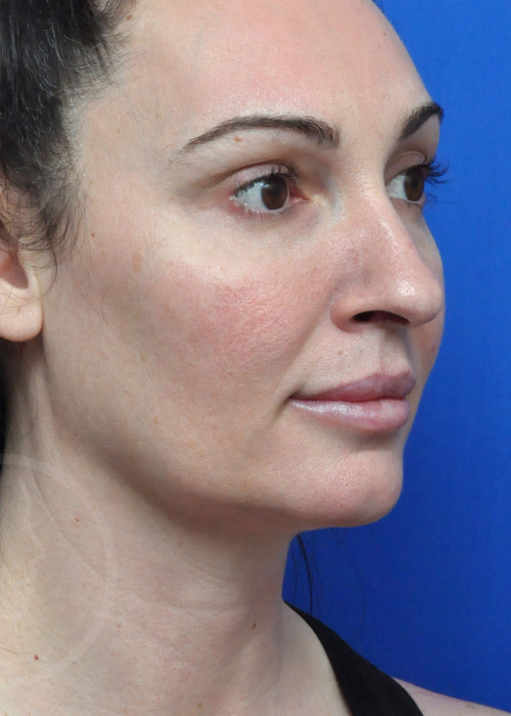 Ultherapy® Before and After in Jacksonville, FL