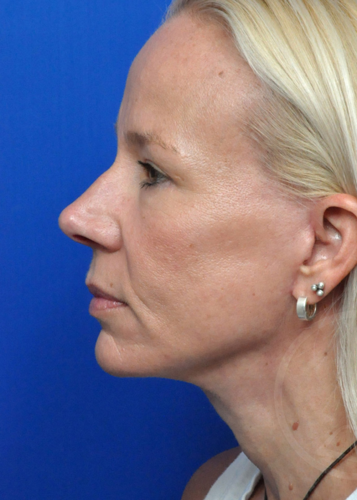 Ultherapy® Before and After in Jacksonville, FL