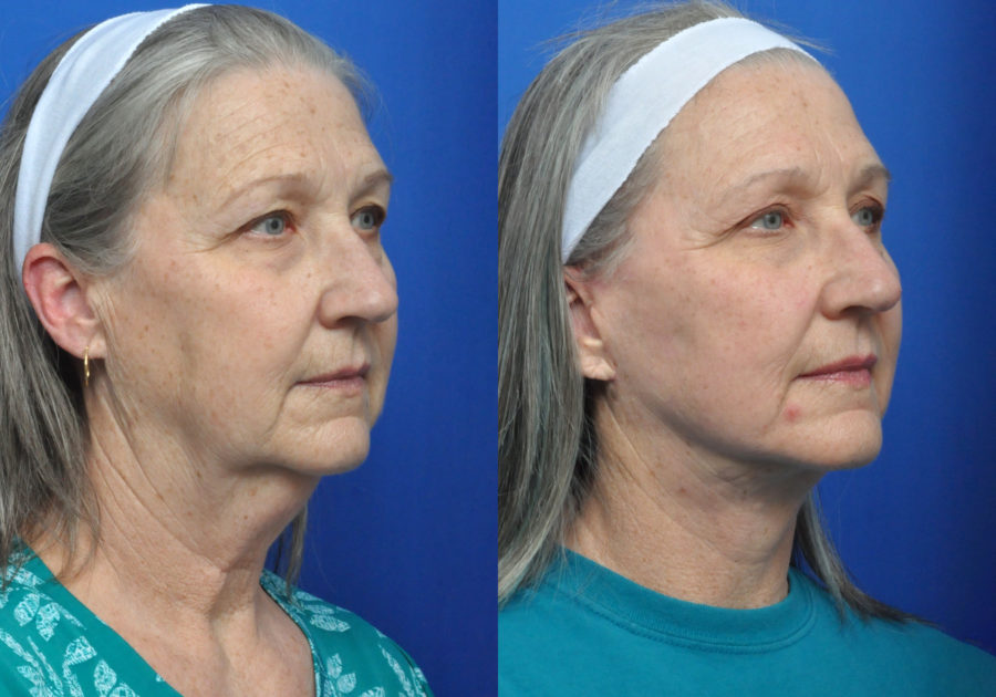Neck Lift in Jacksonville, FL