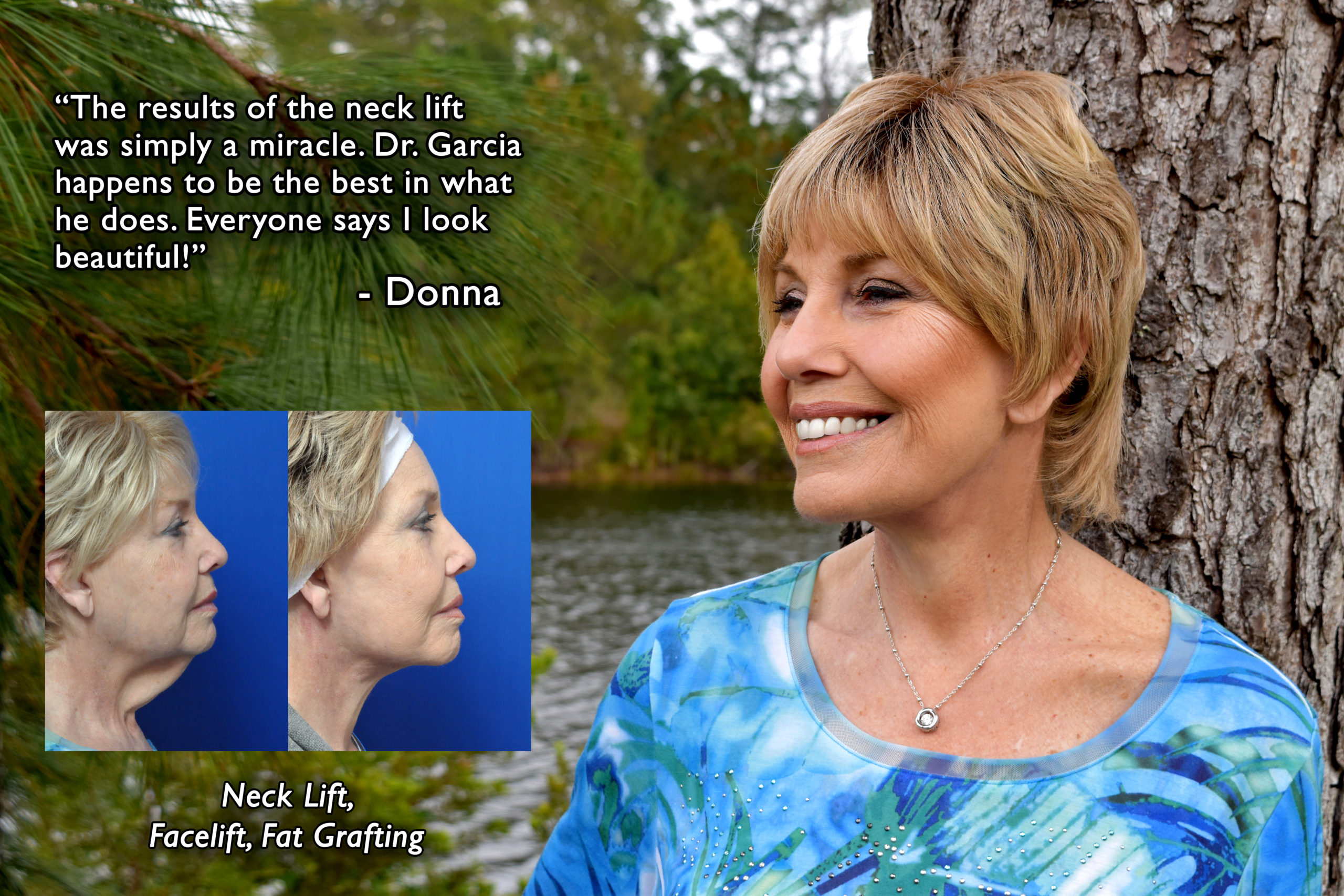 Neck Lift Before and After Pictures Jacksonville, FL