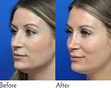 Rhinoplasty Journeys - Garcia Facial Plastic Surgery