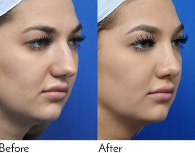 Rhinoplasty Journeys - Garcia Facial Plastic Surgery