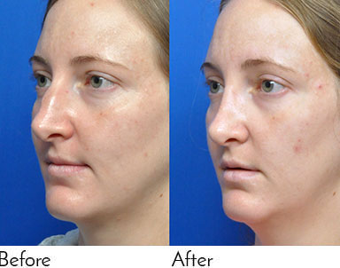 Rhinoplasty Journeys - Garcia Facial Plastic Surgery