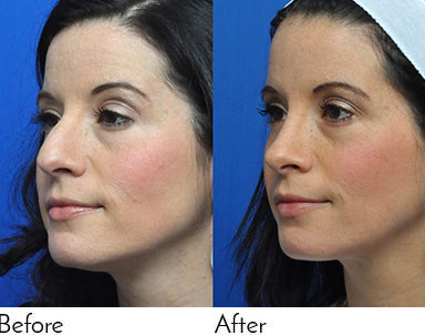 Rhinoplasty Journeys - Garcia Facial Plastic Surgery