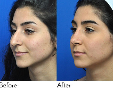 Rhinoplasty Journeys - Garcia Facial Plastic Surgery