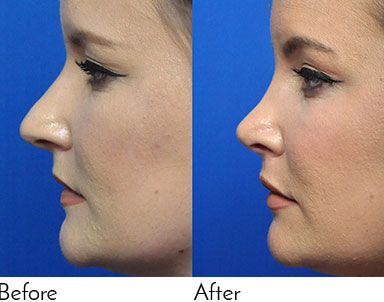 Rhinoplasty Journeys - Garcia Facial Plastic Surgery