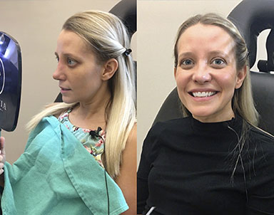 Rhinoplasty Journeys - Garcia Facial Plastic Surgery