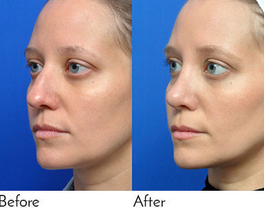 Rhinoplasty Journeys - Garcia Facial Plastic Surgery