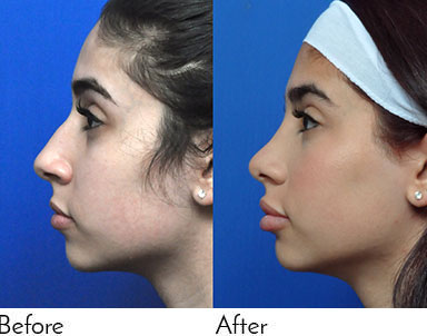 Rhinoplasty Journeys - Garcia Facial Plastic Surgery