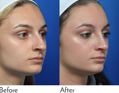 Rhinoplasty Journeys - Garcia Facial Plastic Surgery