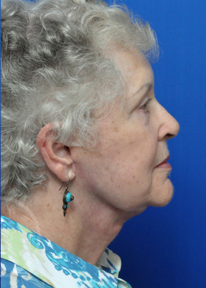 Facelift Before and After Pictures Jacksonville, FL