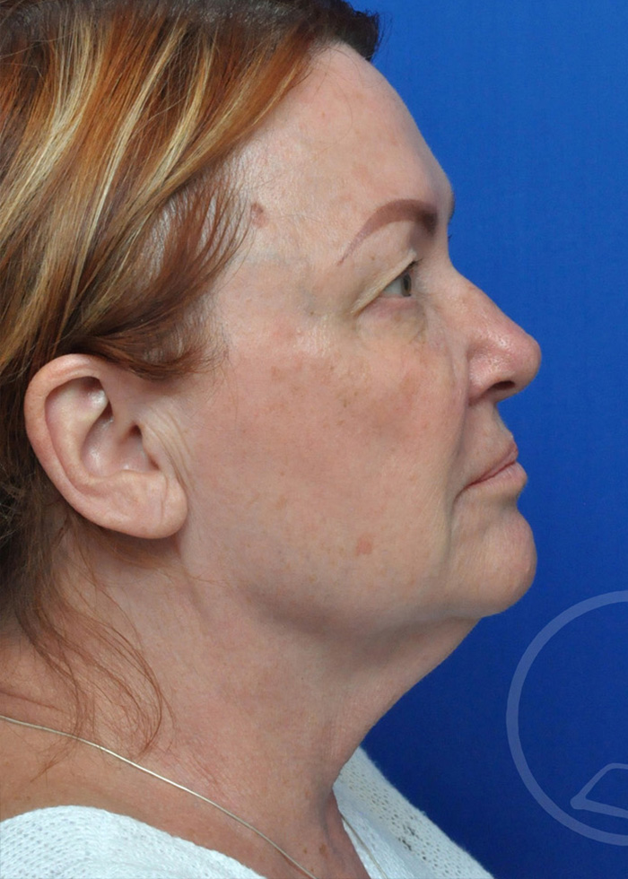 Facelift Before and After Pictures Jacksonville, FL