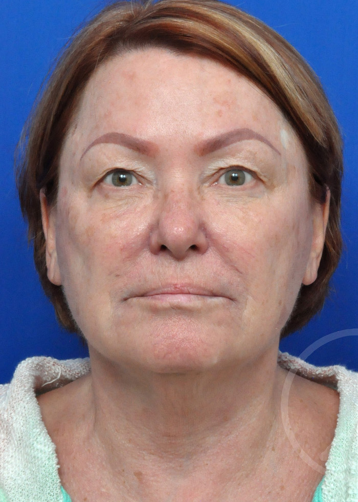 Facelift Before and After Pictures Jacksonville, FL