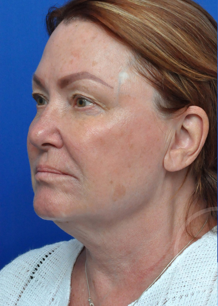 Facelift Before and After Pictures Jacksonville, FL