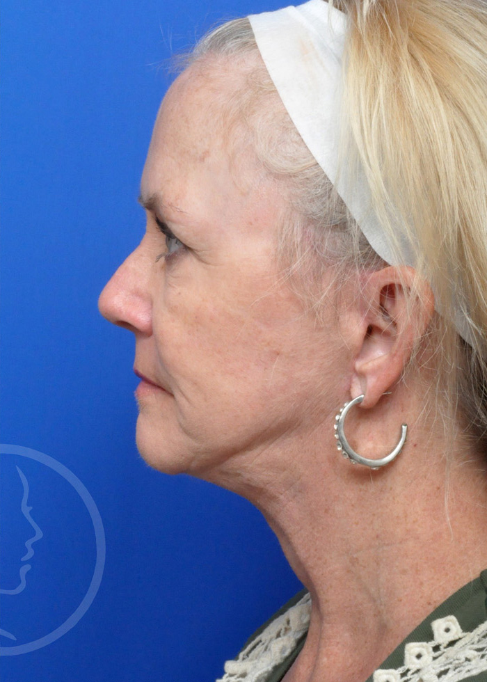 Facelift Before and After Pictures Jacksonville, FL