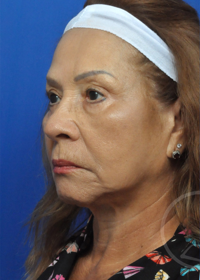 Facelift Before and After Pictures Jacksonville, FL