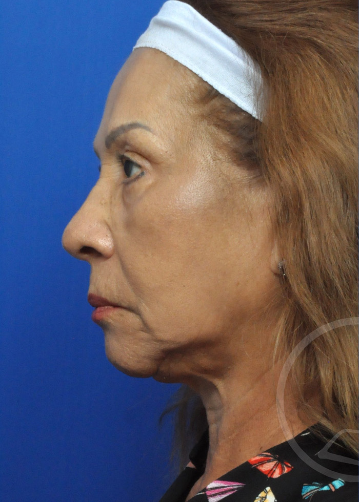 Facelift Before and After Pictures Jacksonville, FL