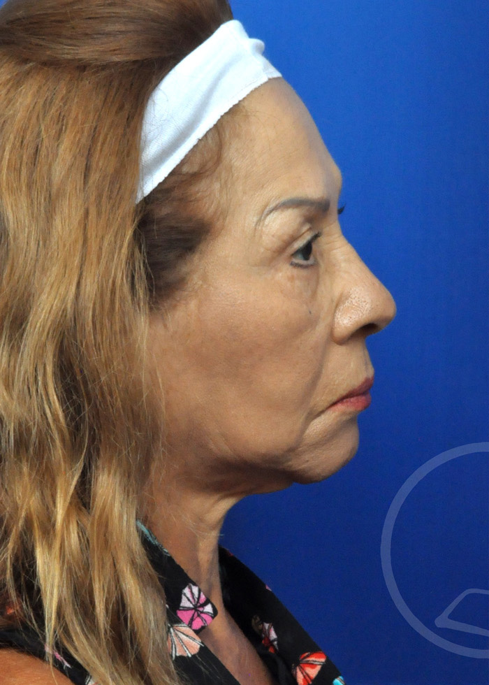 Facelift Before and After Pictures Jacksonville, FL