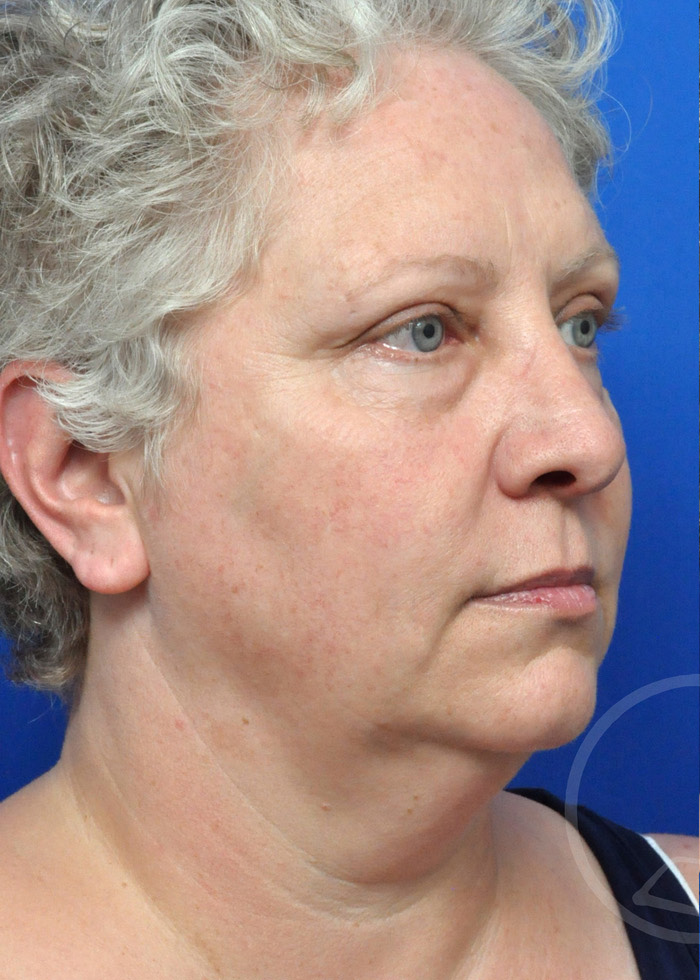 Facelift Before and After Pictures Jacksonville, FL