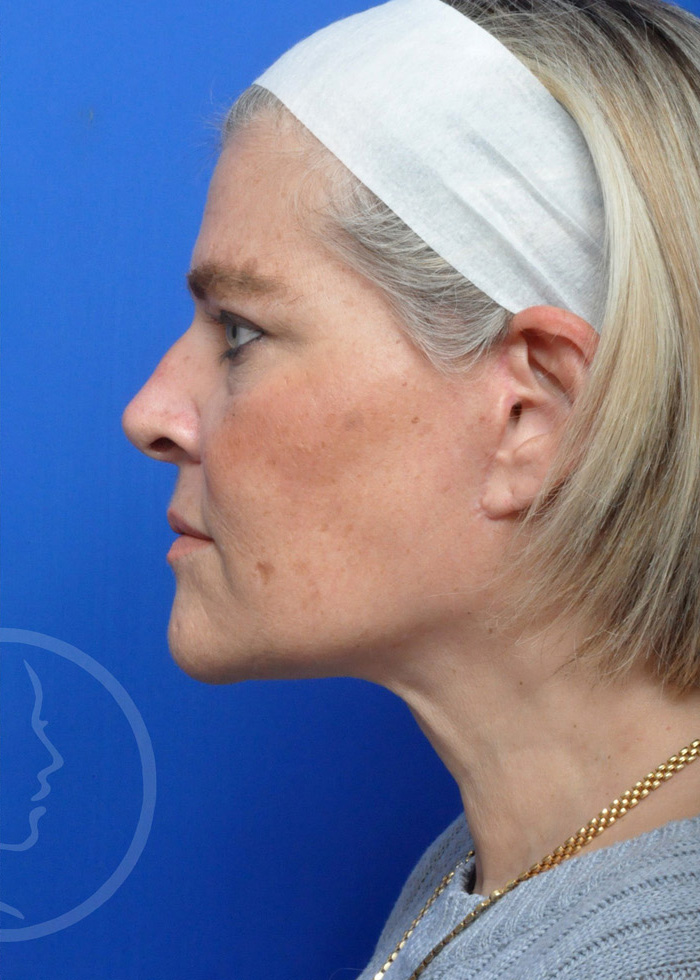 Facelift Before and After Pictures Jacksonville, FL