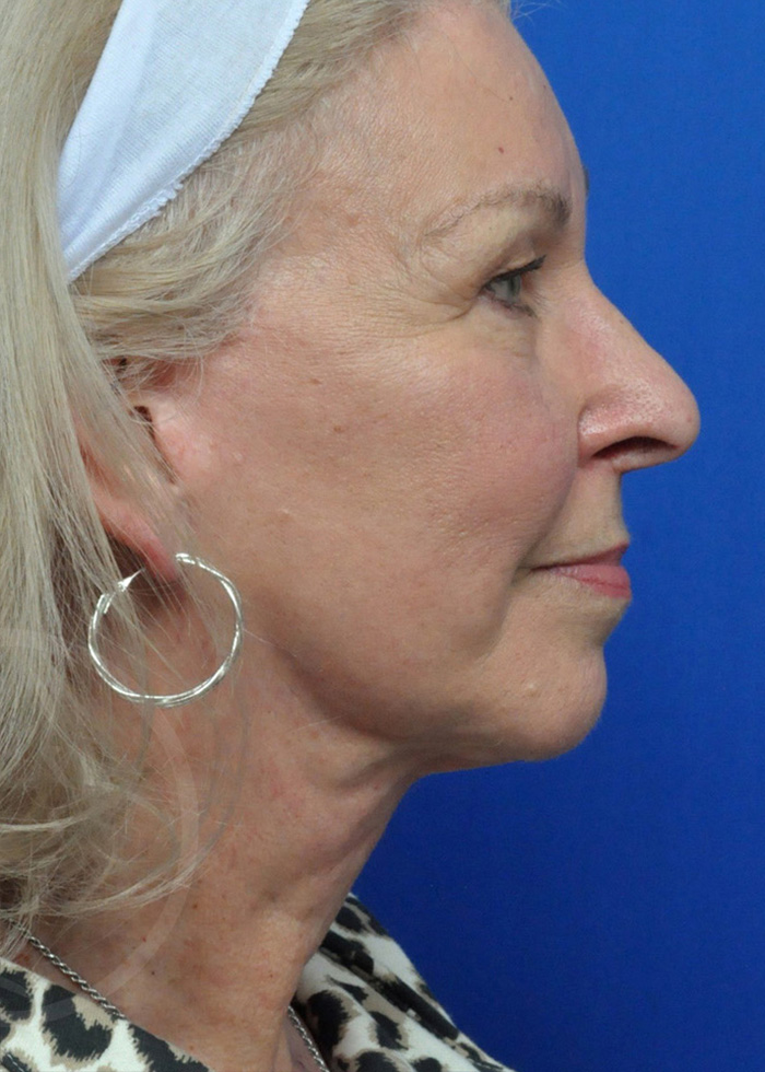 Facelift Before and After Pictures Jacksonville, FL