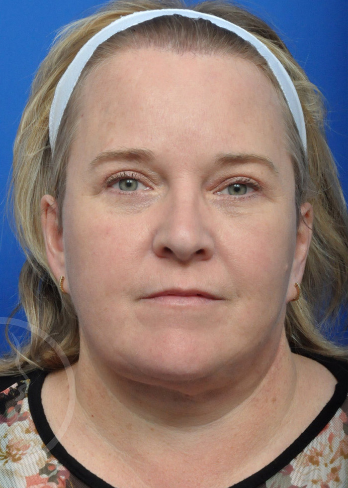 Facelift Before and After Pictures Jacksonville, FL