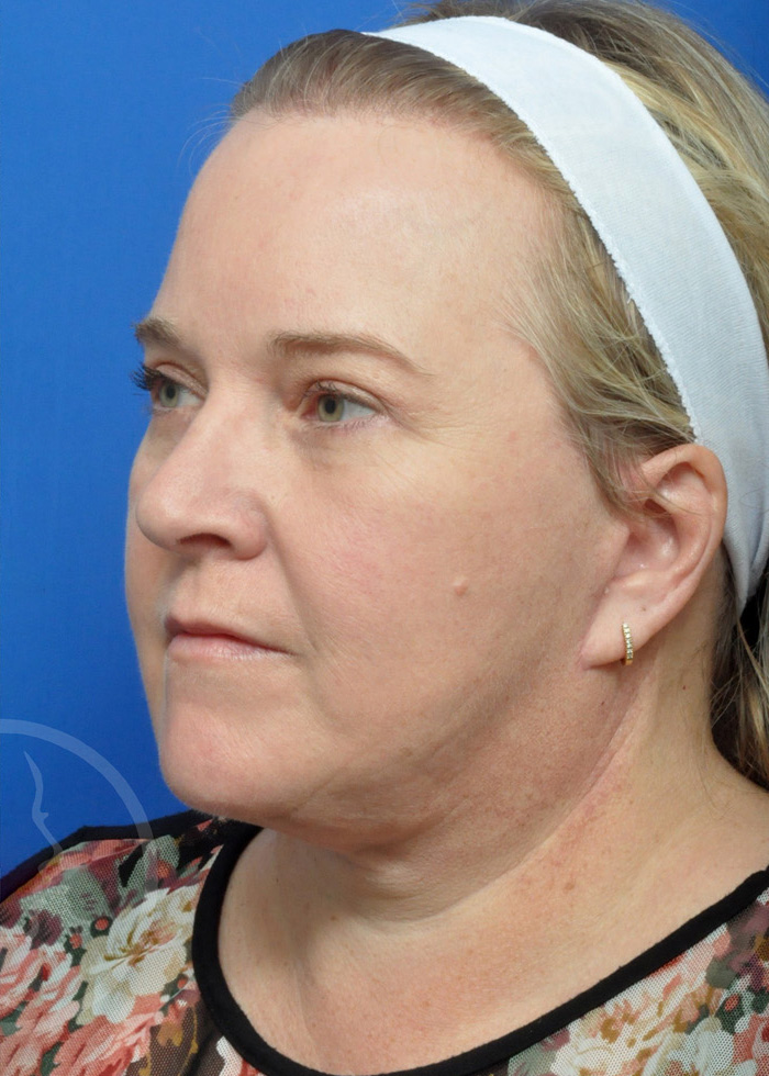 Facelift Before and After Pictures Jacksonville, FL