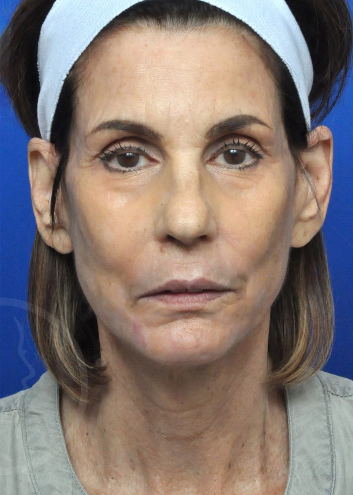 Facelift Before and After Pictures Jacksonville, FL